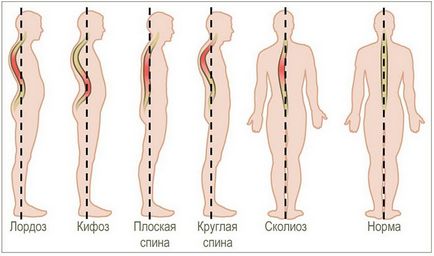 Сколиоза при деца и юноши, лечение, симптоми, причини изкривявания