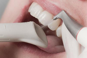 Колко струва един почистване от стоматолог при зъболекаря