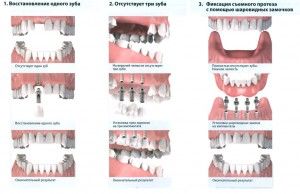 Колко е единичен зъб имплант