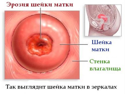 Solkovagina на шийката на матката ерозия - мнения за третиране обгаряне