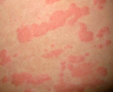 Слънчевата лечение на алергия, превенция, кожни прояви