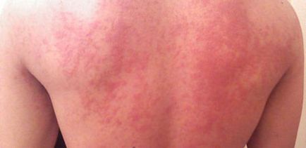 Слънчевата лечение на алергия, превенция, кожни прояви
