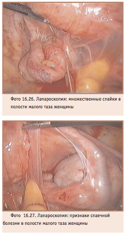 Сраствания на яйчниците, поради които трябва да бъдат лекувани своевременно