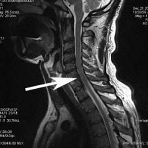 Гръбначните херния признаци, симптоми и лечение, снимка; херния на гръбначния мозък; как да се лекува хората му
