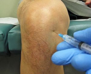 Инжекции (инжекции) в коляното с остеоартрит на коляното на съвместни продукти, правила, мнения