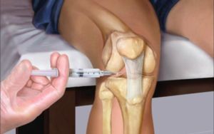 Инжекции (инжекции) в коляното с остеоартрит на коляното на съвместни продукти, правила, мнения