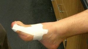 палеца ноктите лечение контузия на стъпалото и облекчаване на болката