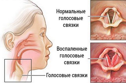 Възлите на щитовидната жлеза в женските симптоми и лечение, което е, какви са последиците
