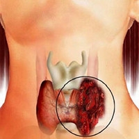 Възлите на щитовидната жлеза в женските симптоми и лечение, което е, какви са последиците