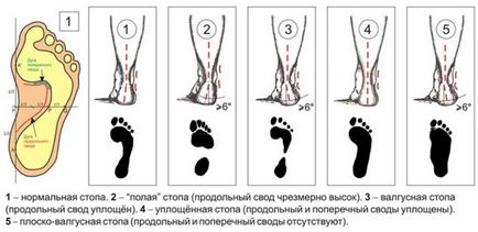 Valgus крак деформация при деца снимка патология