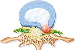 Видове foraminal дискова херния, нейните симптоми, лечение, особено поява