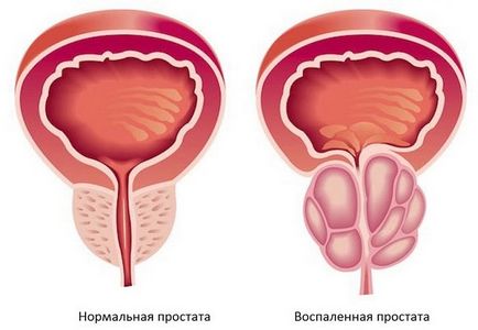 Видове и симптоми на простатит