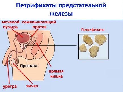 Видове и симптоми на простатит