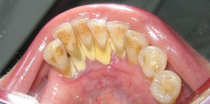 Зъби падат - какво да правите, ако сте загубили зъб