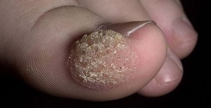 От HPV (на вируса) вирус папиломатоза