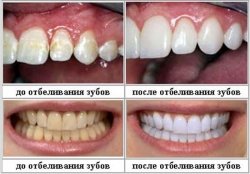 Осемте най-добрите начини за избелване на зъбите в домашни условия