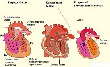 Вродените сърдечни заболявания и причините за тях, поръчване, жалби, диагностика, лечение