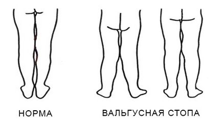 Информация за валгус деформация на краката при деца - масаж, лечение