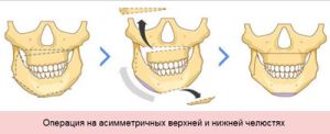 Оперативна корекция на ухапване, когато е необходима операция, реални усложнения (челюстта хирургия за коригиране на захапката) Оперативна корекция на ухапване, когато е необходима операция, реални усложнения