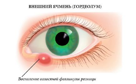 Ечемик на окото как да се лекува бързо у дома, домашно лечение, лечение