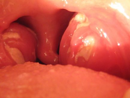 Подуване на езика причинява заболяването и начините за лечение на заболяването
