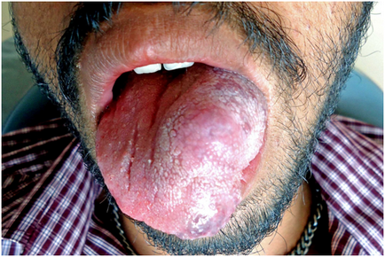 Подуване на езика причинява заболяването и начините за лечение на заболяването