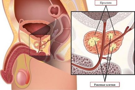 Заболявания на простатната жлеза при мъжете простатата различни диагнози и общи каузи