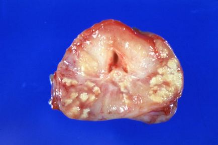 Заболявания на простатната жлеза при мъжете простатата различни диагнози и общи каузи