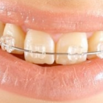 Защо почистване при зъболекаря професионални зъби