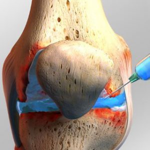 Течността в коляното, която правя, лечение, защо се събира течност в коляното