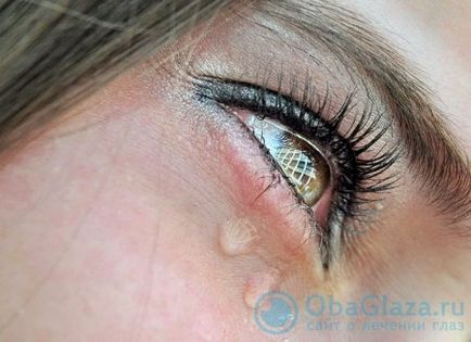 9 начина как да се премахнат очите оток със сълзи след