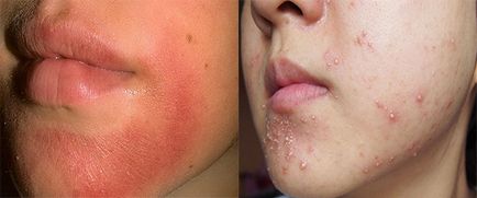 Алергия към крем за лице причини, симптоми, лечение