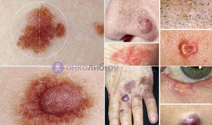 Базално-клетъчен карцином на кожата симптоми, лечение и отстраняване, снимка