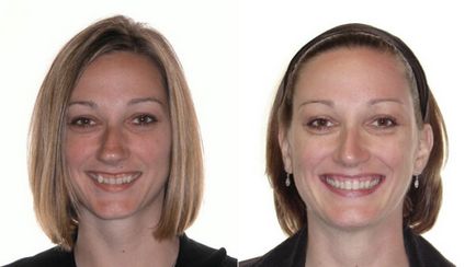 Скоби преди и след - снимка работи зъболекари