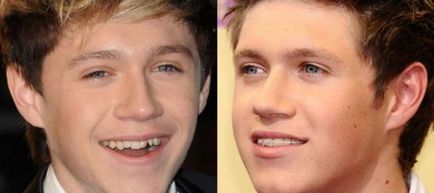 Скоби преди и след - снимка работи зъболекари