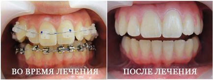 Скоби различни системи, снимка преди и след инсталацията (керамика) Презрамки различни системи, снимка преди и след инсталацията