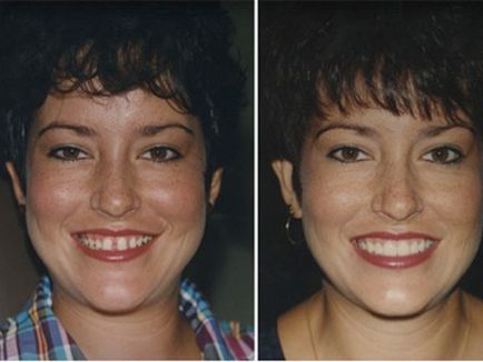 Снимки преди и след скоби момичета, момчета и възрастни