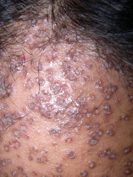 Хиперкератоза на типове кожа, симптоми, лечение