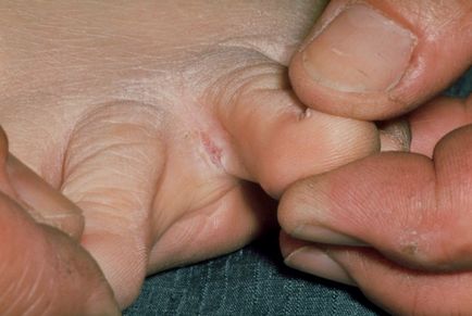 Гъбички между пръстите на краката лечение у дома ефективно