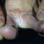 Гъбички между пръстите на краката се покажат симптоми, изберете лечение