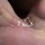Гъбички между пръстите на краката се покажат симптоми, изберете лечение