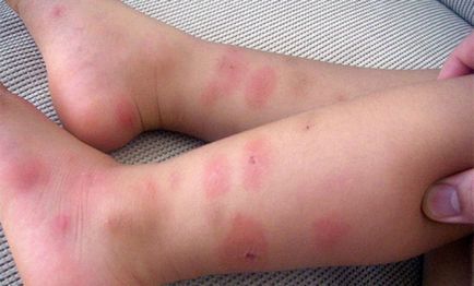 Как да се облекчи състоянието на детето ухапване от комари