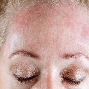 Как да се проявят симптоми на алергия към крем за лице, какво да се прави в такива случаи - всичко за алергия
