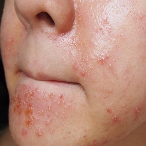 Как да се проявят симптоми на алергия към крем за лице, какво да се прави в такива случаи - всичко за алергия