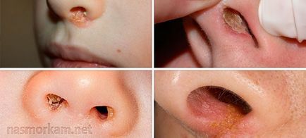 Напластяванията в носа причини и лечение
