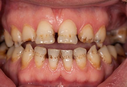 Лазерно избелване на зъбите е, че такива предимства, цени, снимки и коментари пациенти