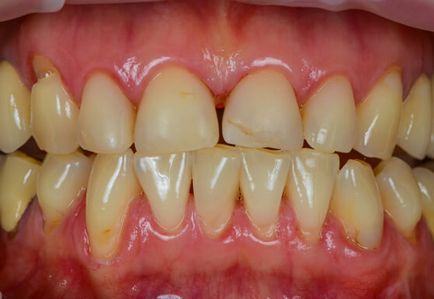 Лазерно избелване на зъбите е, че такива предимства, цени, снимки и коментари пациенти