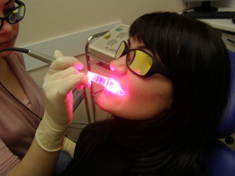 Лазерно избелване на зъби и против