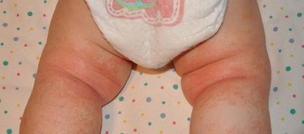 бодлив топлинна обработка при бебета, както и за лечение от бодлив топлина при новороденото (grudnichka) бодлив топлинна обработка при бебета, както и за лечение от бодлив топлина при новороденото