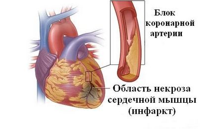 Обширни миокарден инфаркт последици